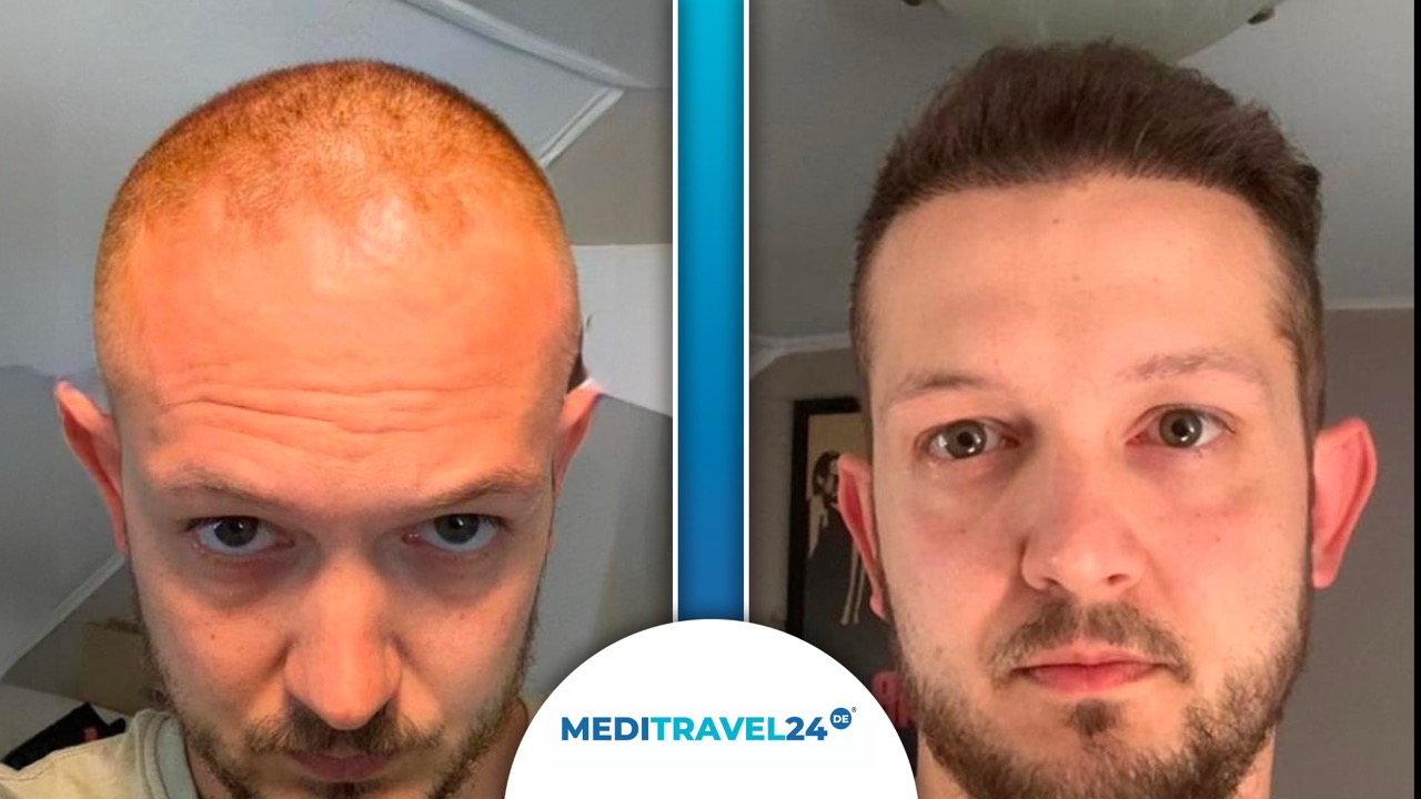 Vorher-Nachher Bild 4