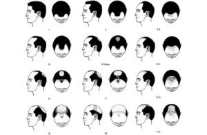 Norwood baldness scale