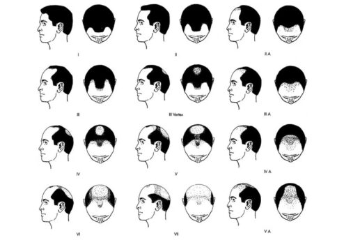 Norwood baldness scale